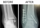 1280px-Trimalleolar_Ankle_Fracture_Xray_shown_before_surgery_and_after_surgery.png